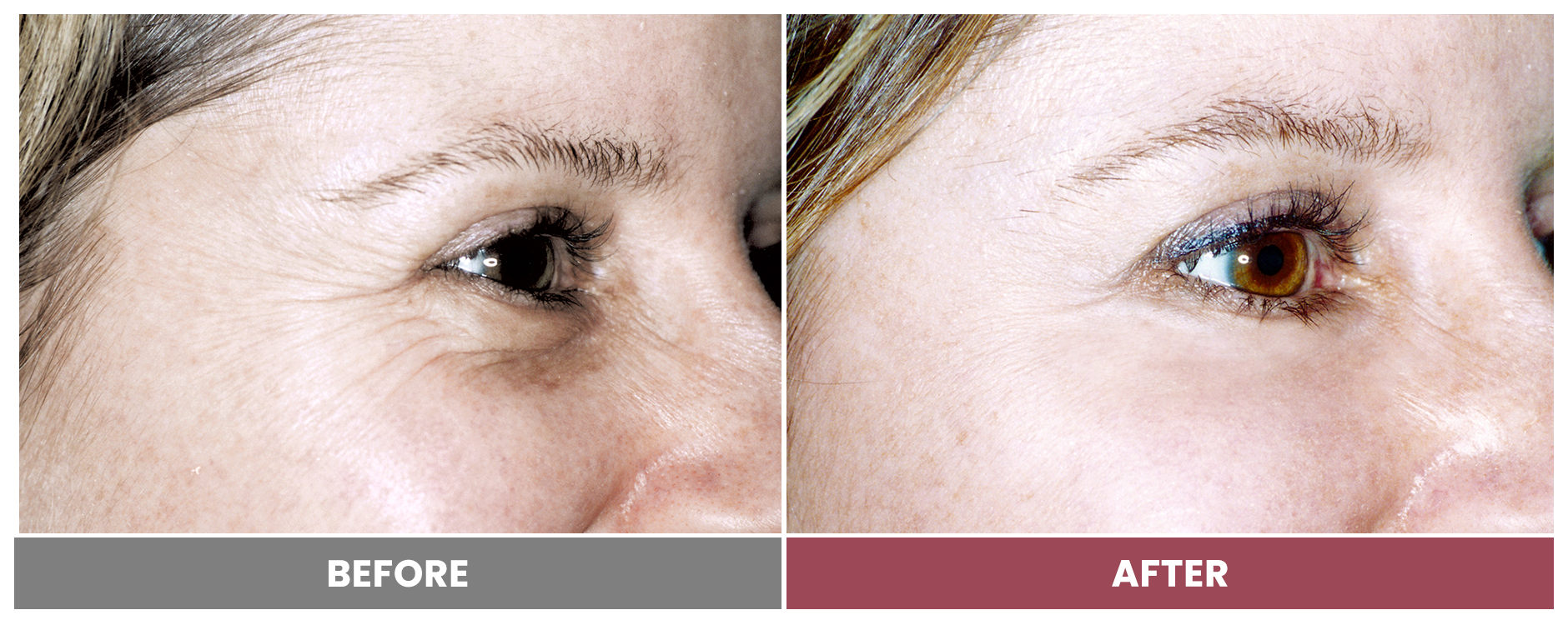 LASER SKIN RESURFACING - Case 2